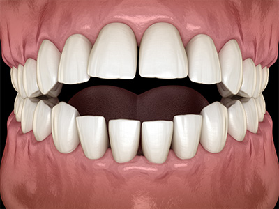 Green Ridge Dental Care | Implant Dentistry, Teeth Whitening and Veneers