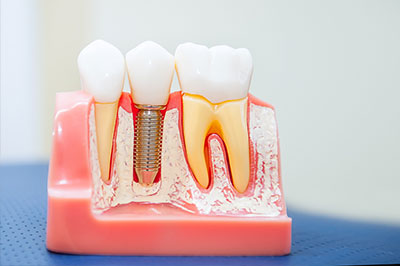 Green Ridge Dental Care | Ceramic Crowns, Sports Mouthguards and Pediatric Dentistry