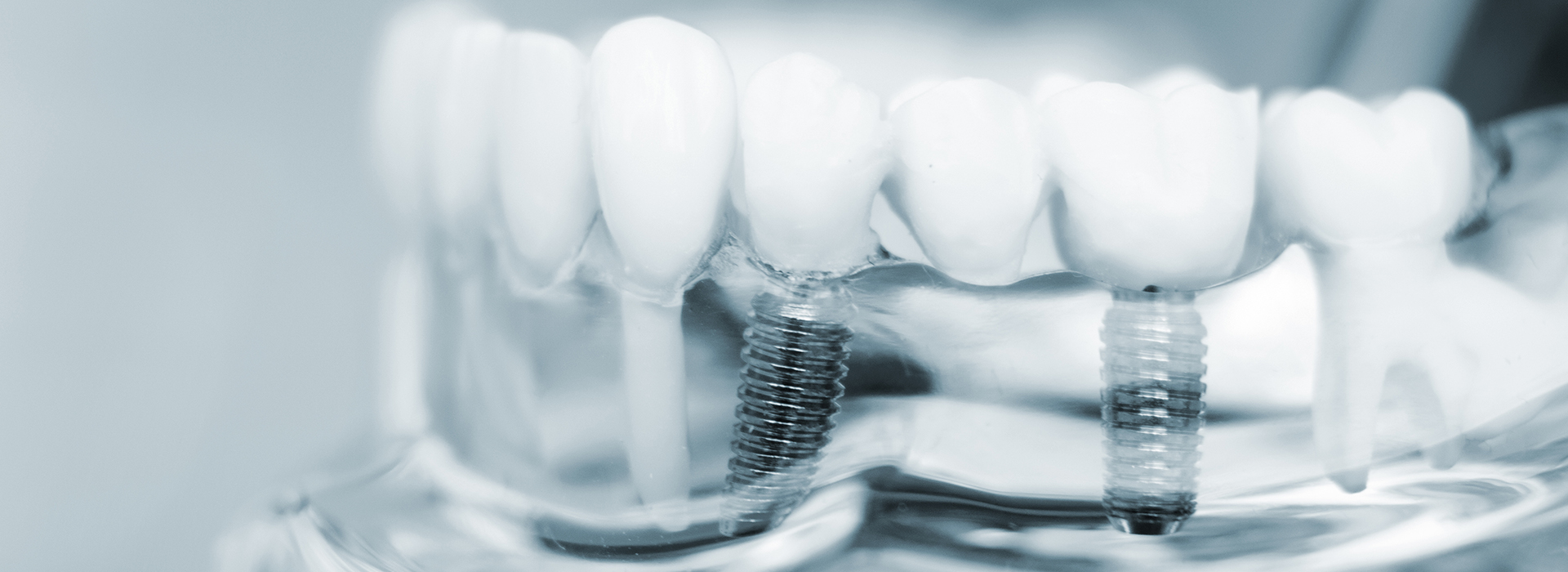 Green Ridge Dental Care | Implant Dentistry, Pediatric Dentistry and Dental Fillings
